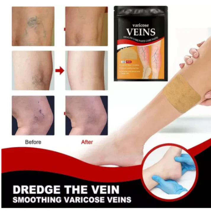 🌸2x1 Di adiós a las molestias de las varices con nuestro innovador parche!